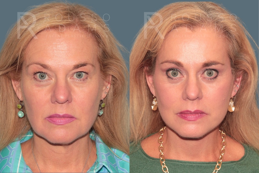 Deep Plane Facelift <span class=small>By Dr. Austin Adams</span> Before & After Gallery - Patient 371445 - Image 2