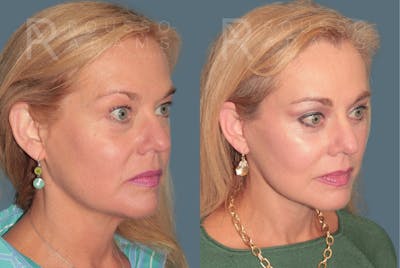 Deep Plane Facelift <span class=small>By Dr. Austin Adams</span> Before & After Gallery - Patient 371445 - Image 1