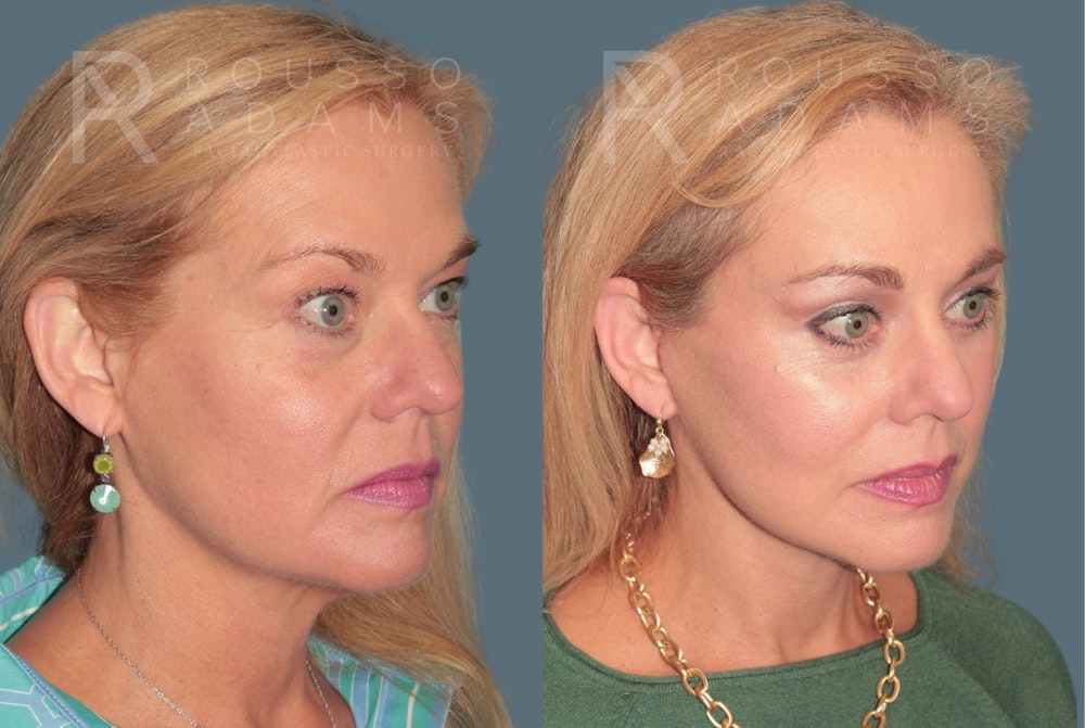 Deep Plane Facelift <span class=small>By Dr. Austin Adams</span> Before & After Gallery - Patient 371445 - Image 1