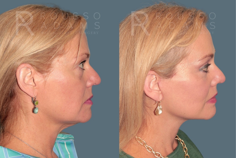 Deep Plane Facelift <span class=small>By Dr. Austin Adams</span> Before & After Gallery - Patient 371445 - Image 3