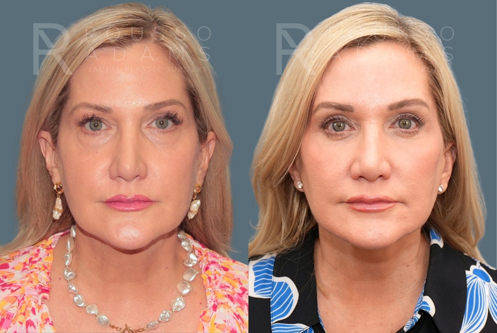Deep Plane Facelift <span class=small>By Dr. Austin Adams</span> Before & After Gallery - Patient 409145 - Image 3