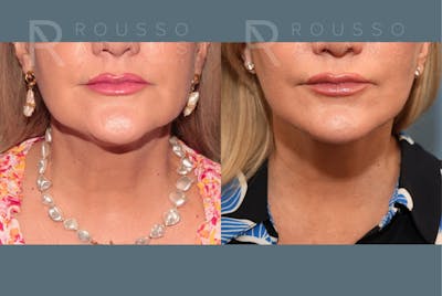 Deep Plane Facelift <span class=small>By Dr. Austin Adams</span> Before & After Gallery - Patient 409145 - Image 6