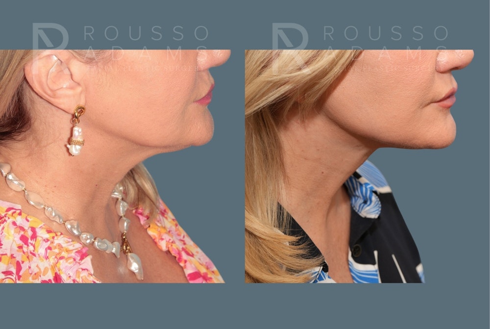 Deep Plane Facelift <span class=small>By Dr. Austin Adams</span> Before & After Gallery - Patient 409145 - Image 4
