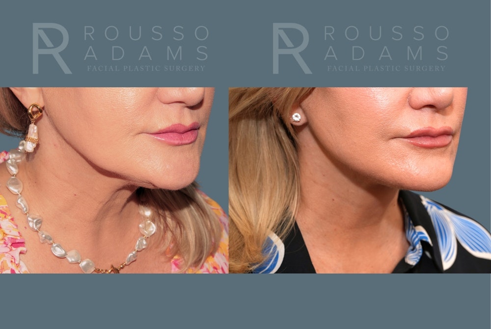Deep Plane Facelift <span class=small>By Dr. Austin Adams</span> Before & After Gallery - Patient 409145 - Image 5