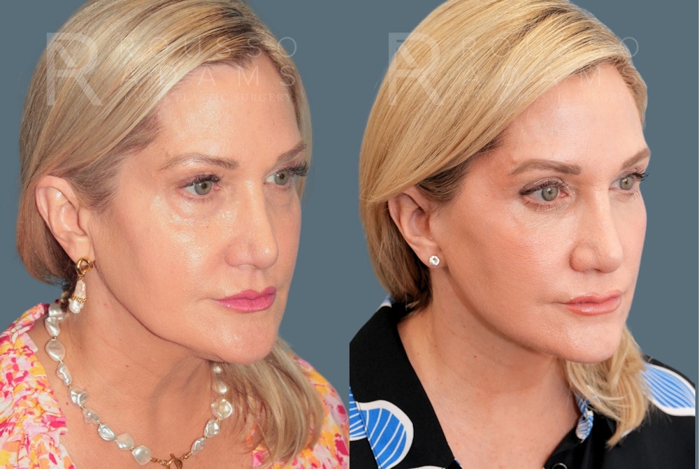 Deep Plane Facelift <span class=small>By Dr. Austin Adams</span> Before & After Gallery - Patient 409145 - Image 1