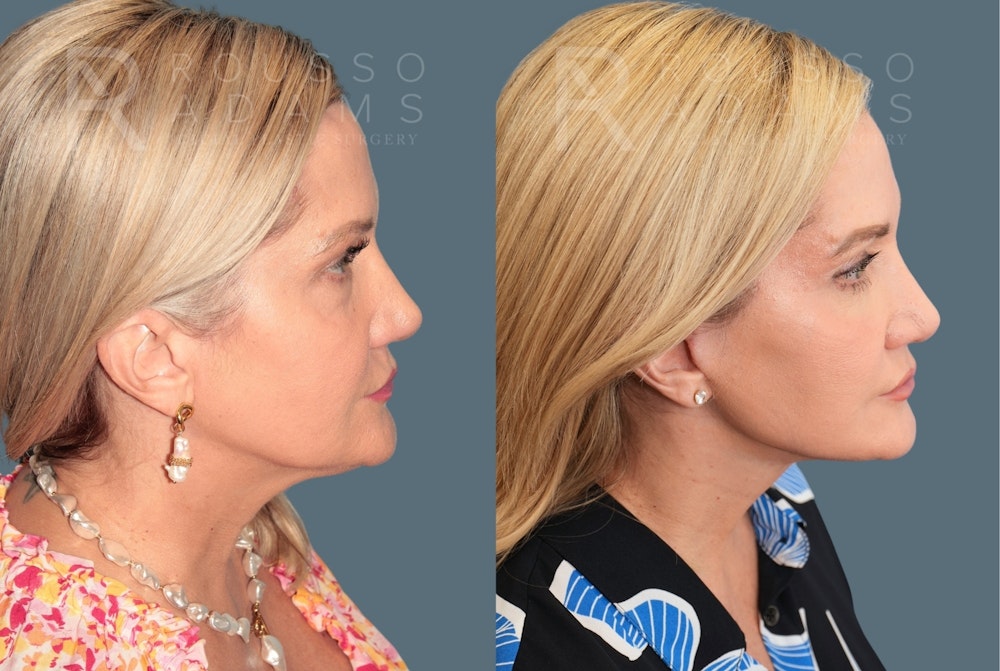 Deep Plane Facelift <span class=small>By Dr. Austin Adams</span> Before & After Gallery - Patient 409145 - Image 2