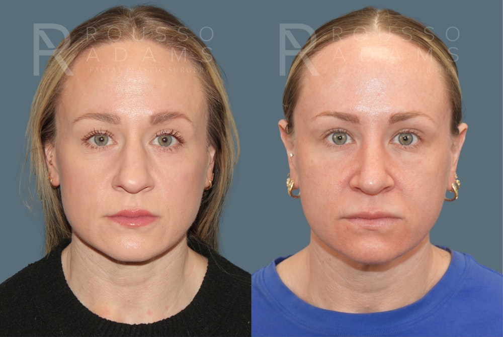 Rhinoplasty<span class=small>By Dr. Austin Adams</span> Before & After Gallery - Patient 386090 - Image 3