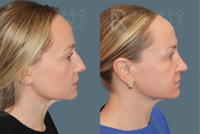Rhinoplasty<span class=small>By Dr. Austin Adams</span> Before & After Gallery - Patient 386090 - Image 1