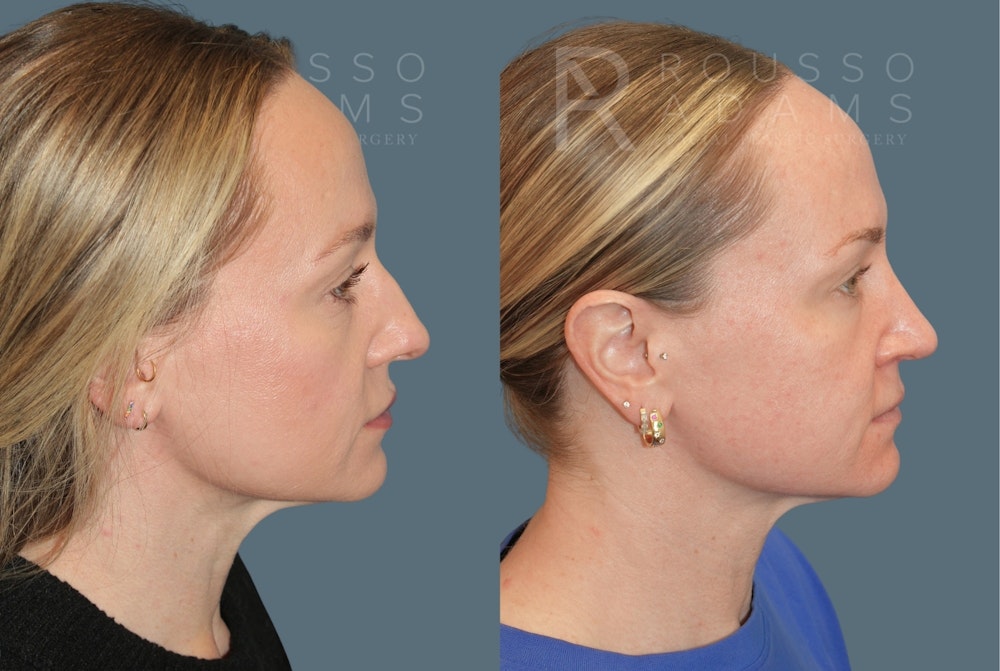 Rhinoplasty<span class=small>By Dr. Austin Adams</span> Before & After Gallery - Patient 386090 - Image 1