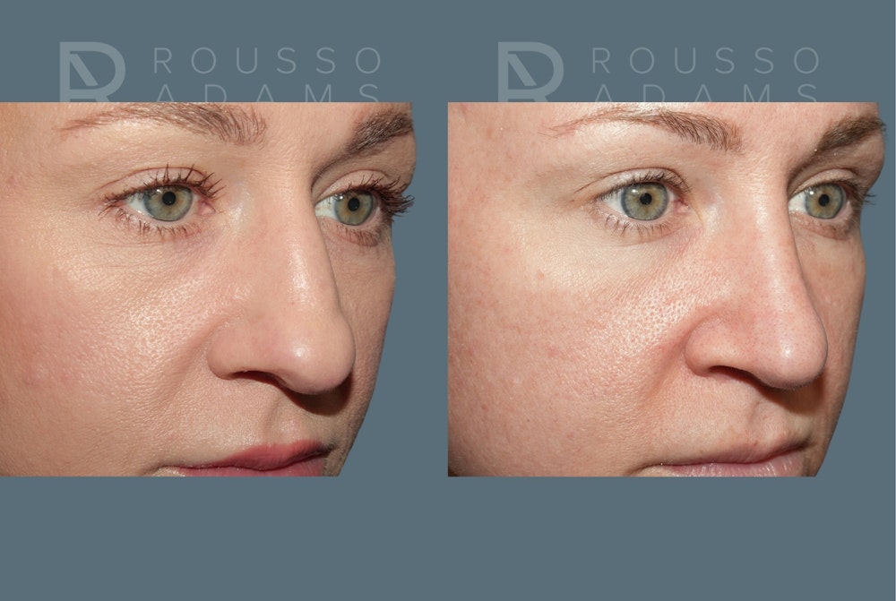 Rhinoplasty<span class=small>By Dr. Austin Adams</span> Before & After Gallery - Patient 386090 - Image 4