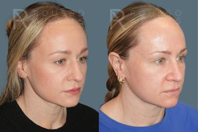 Rhinoplasty<span class=small>By Dr. Austin Adams</span> Before & After Gallery - Patient 386090 - Image 2