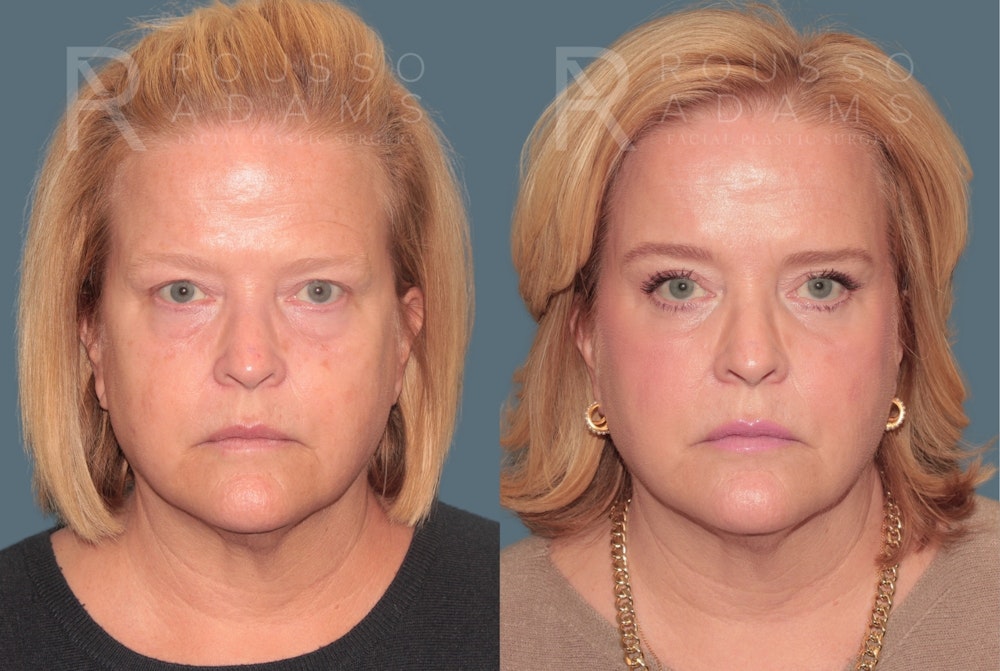 Blepharoplasty<span class=small>By Dr. Austin Adams</span> Before & After Gallery - Patient 119251 - Image 4