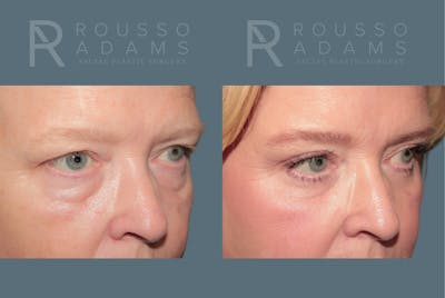 Blepharoplasty<span class=small>By Dr. Austin Adams</span> Before & After Gallery - Patient 119251 - Image 2