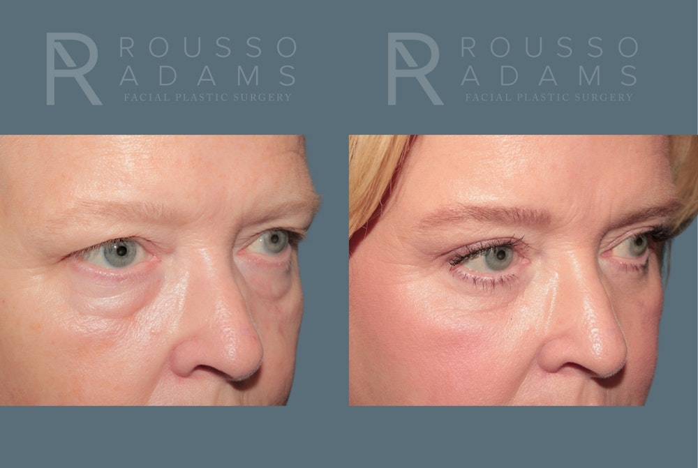 Blepharoplasty<span class=small>By Dr. Austin Adams</span> Before & After Gallery - Patient 119251 - Image 2