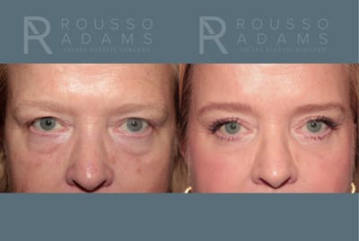 Blepharoplasty<span class=small>By Dr. Austin Adams</span> Before & After Gallery - Patient 119251 - Image 1