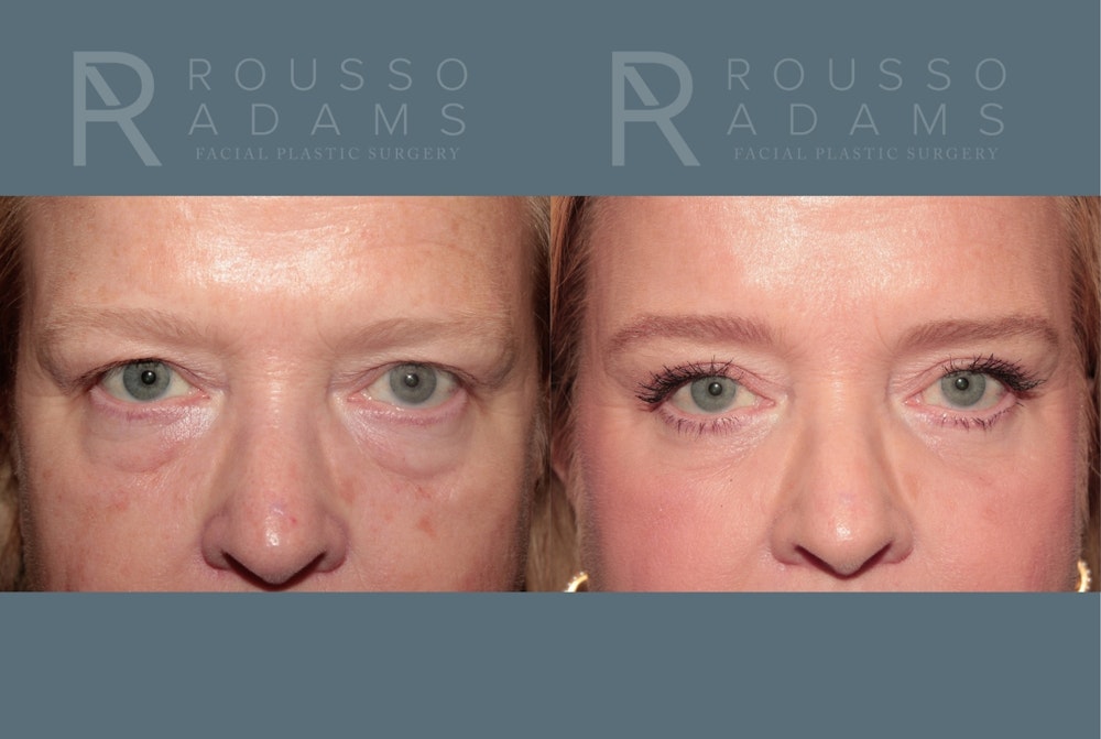 Blepharoplasty<span class=small>By Dr. Austin Adams</span> Before & After Gallery - Patient 119251 - Image 1
