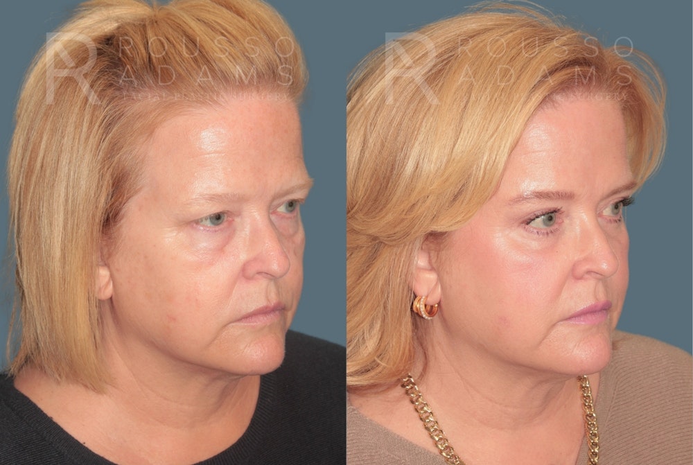 Blepharoplasty<span class=small>By Dr. Austin Adams</span> Before & After Gallery - Patient 119251 - Image 3