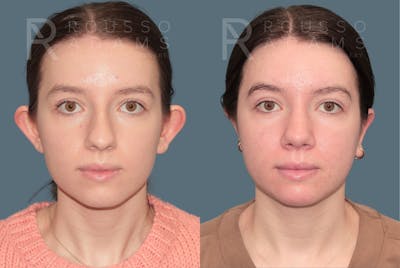 Otoplasty <span class=small>By Dr. Daniel Rousso</span> Before & After Gallery - Patient 192069 - Image 1