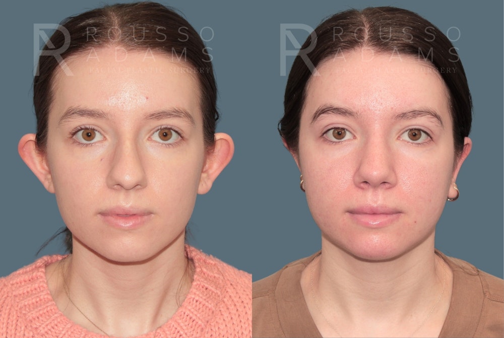 Otoplasty <span class=small>By Dr. Daniel Rousso</span> Before & After Gallery - Patient 192069 - Image 1