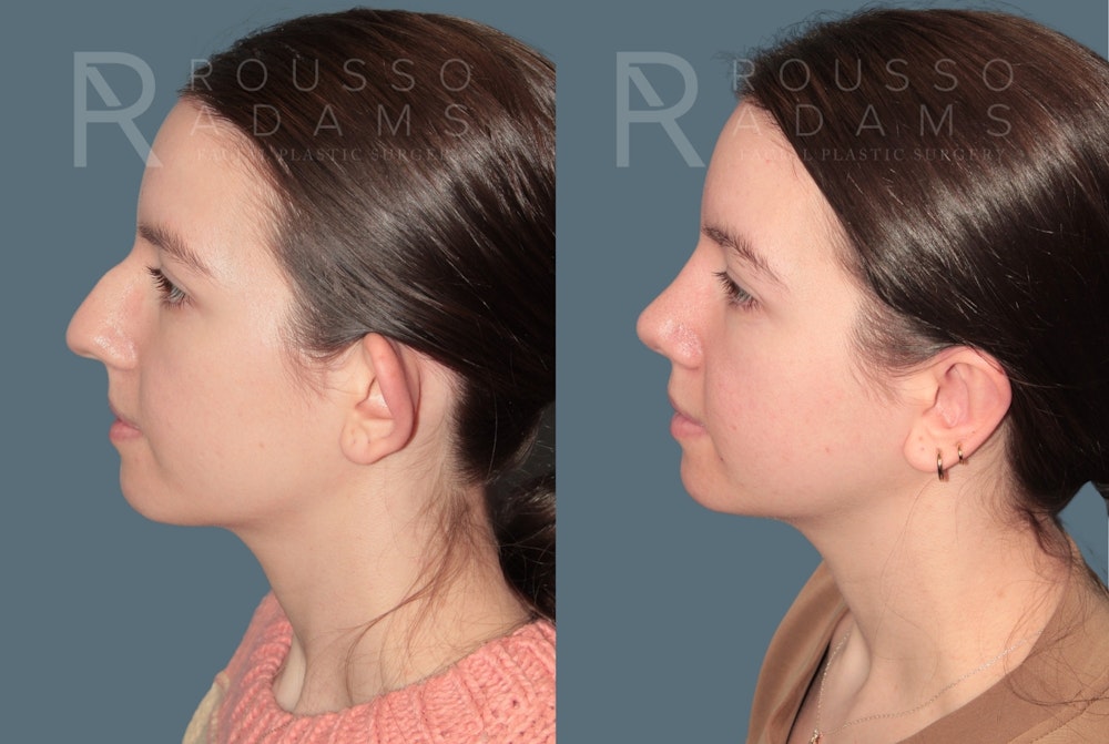 Otoplasty <span class=small>By Dr. Daniel Rousso</span> Before & After Gallery - Patient 192069 - Image 4