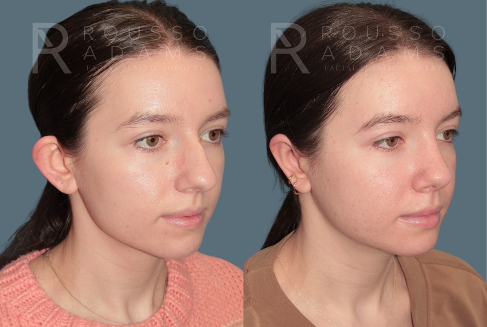 Otoplasty <span class=small>By Dr. Daniel Rousso</span> Before & After Gallery - Patient 192069 - Image 3