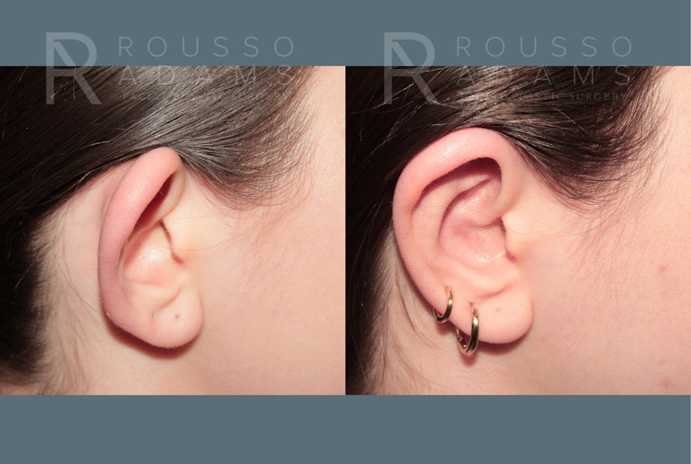 Otoplasty <span class=small>By Dr. Daniel Rousso</span> Before & After Gallery - Patient 192069 - Image 2
