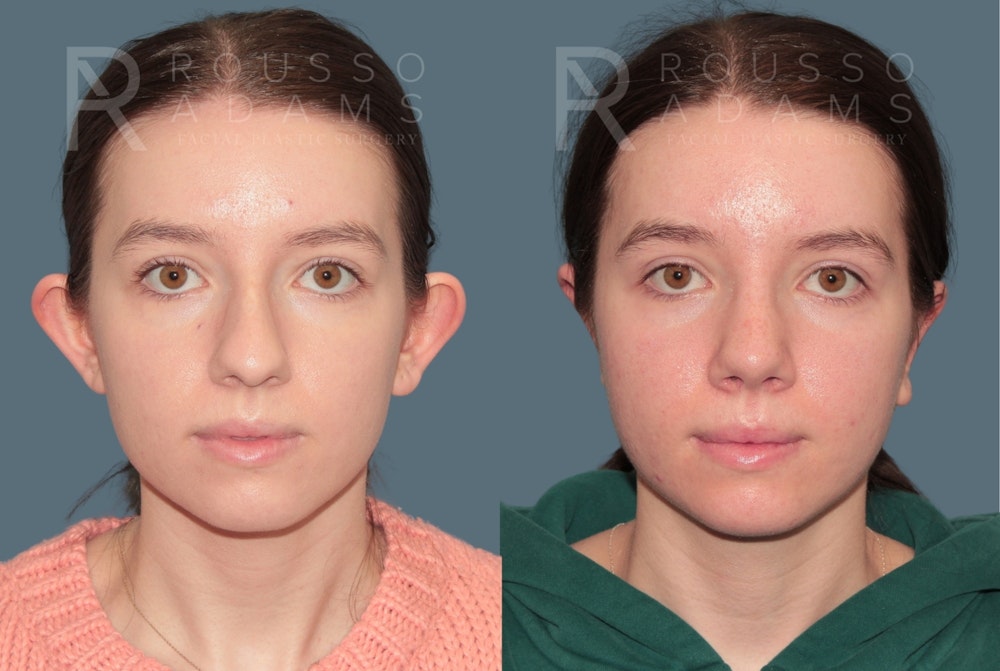 Rhinoplasty <span class=small>By Dr. Daniel Rousso</span> Before & After Gallery - Patient 178400 - Image 3