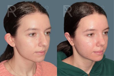 Rhinoplasty <span class=small>By Dr. Daniel Rousso</span> Before & After Gallery - Patient 178400 - Image 4