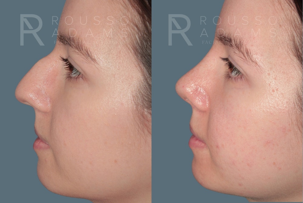 Rhinoplasty <span class=small>By Dr. Daniel Rousso</span> Before & After Gallery - Patient 178400 - Image 2