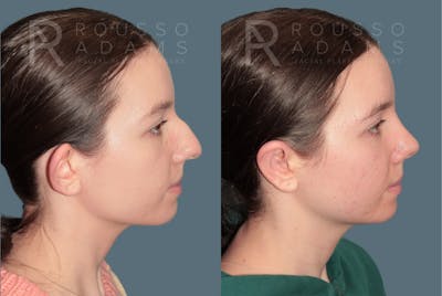 Rhinoplasty <span class=small>By Dr. Daniel Rousso</span> Before & After Gallery - Patient 178400 - Image 1