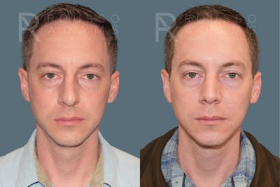 Rhinoplasty <span class=small>By Dr. Daniel Rousso</span> Before & After Gallery - Patient 318207 - Image 4