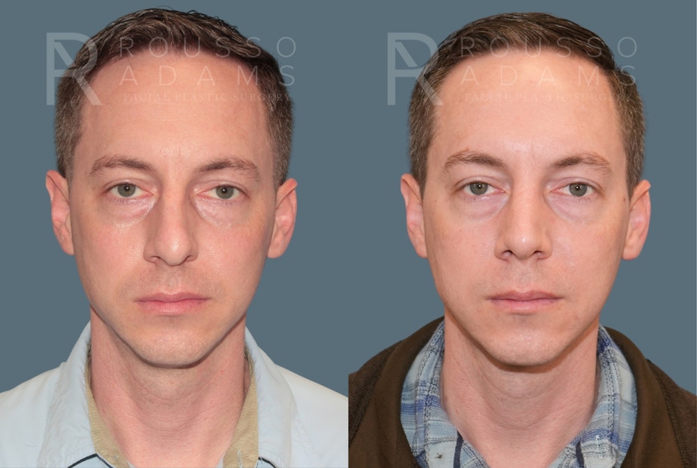Rhinoplasty <span class=small>By Dr. Daniel Rousso</span> Before & After Gallery - Patient 318207 - Image 4