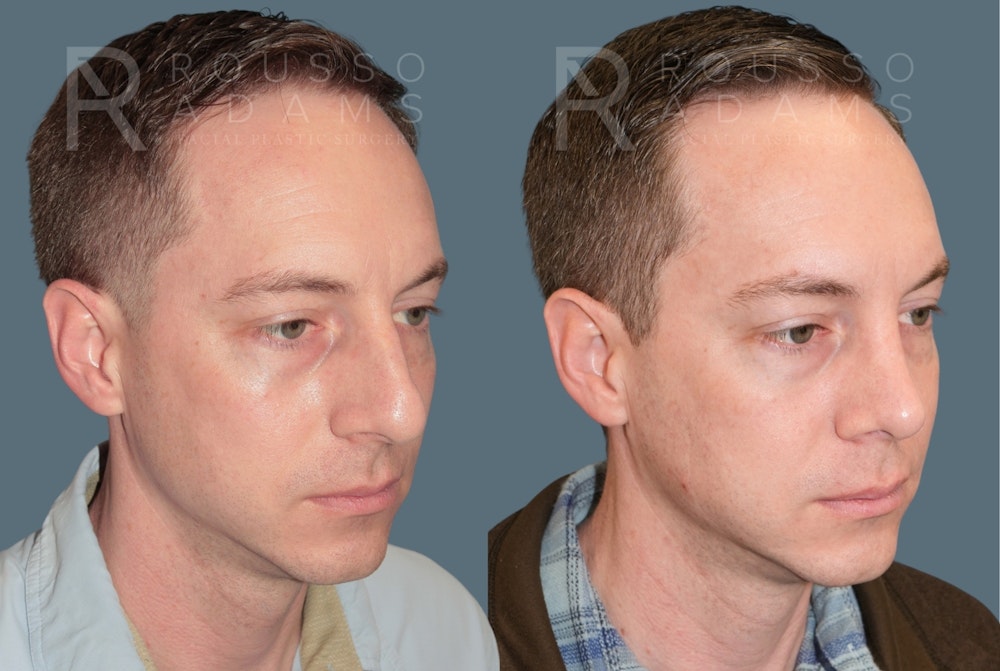 Rhinoplasty <span class=small>By Dr. Daniel Rousso</span> Before & After Gallery - Patient 318207 - Image 3