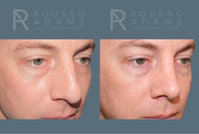 Rhinoplasty <span class=small>By Dr. Daniel Rousso</span> Before & After Gallery - Patient 318207 - Image 2