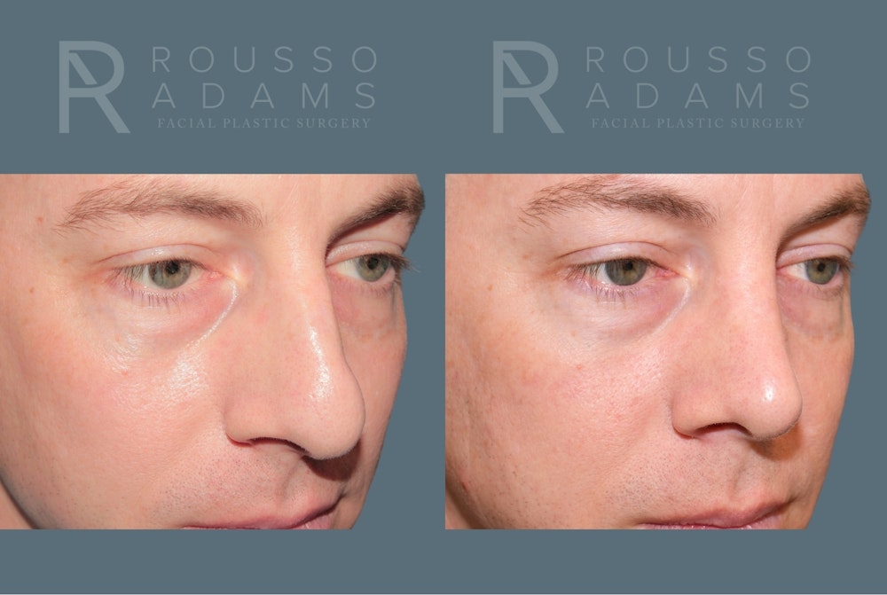 Rhinoplasty <span class=small>By Dr. Daniel Rousso</span> Before & After Gallery - Patient 318207 - Image 2
