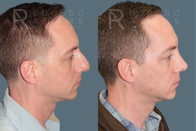 Rhinoplasty <span class=small>By Dr. Daniel Rousso</span> Before & After Gallery - Patient 318207 - Image 1