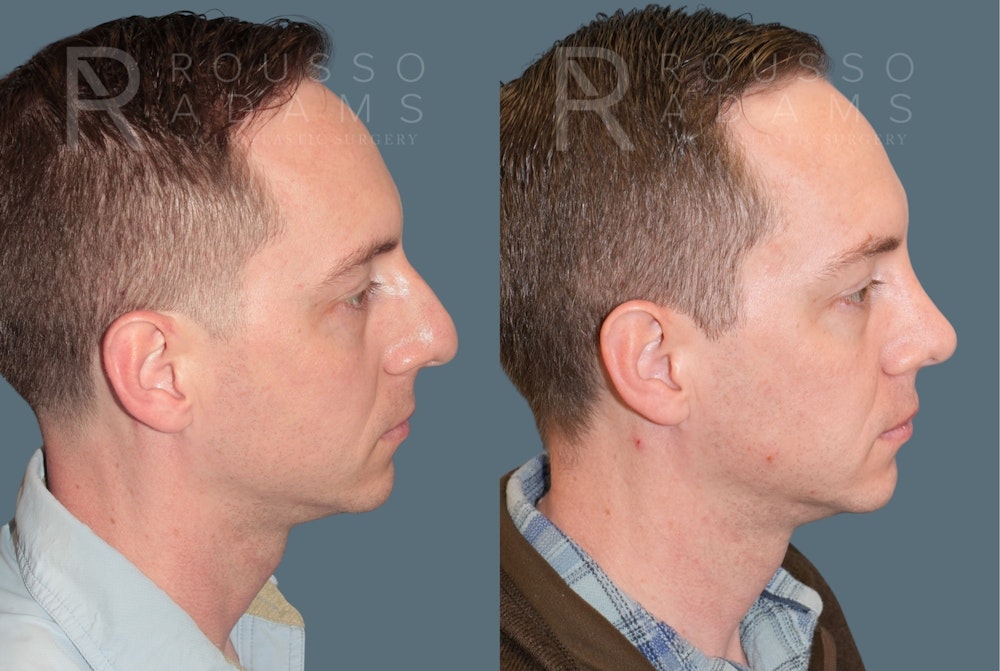 Rhinoplasty <span class=small>By Dr. Daniel Rousso</span> Before & After Gallery - Patient 318207 - Image 1