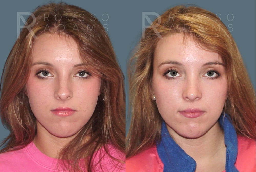 Rhinoplasty <span class=small>By Dr. Daniel Rousso</span> Before & After Gallery - Patient 271725 - Image 5