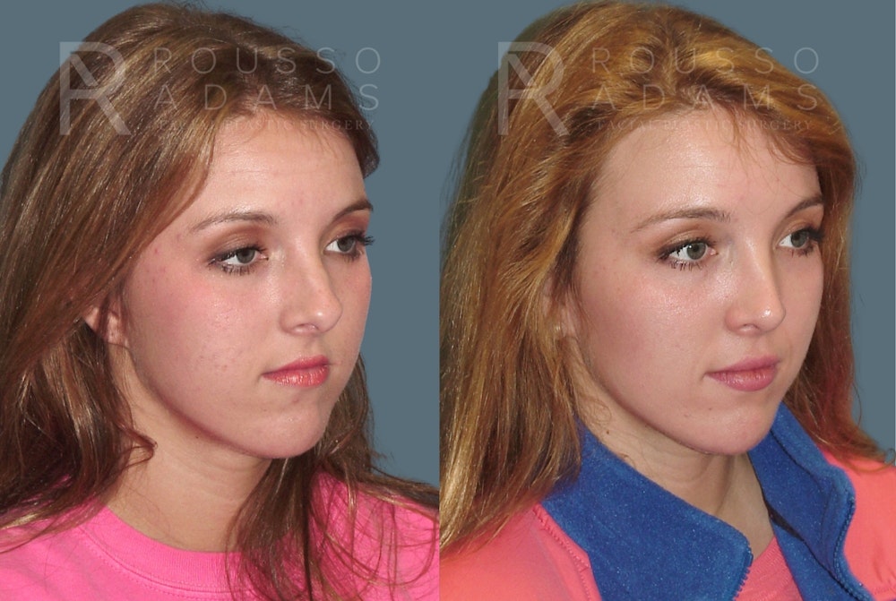 Rhinoplasty <span class=small>By Dr. Daniel Rousso</span> Before & After Gallery - Patient 271725 - Image 3