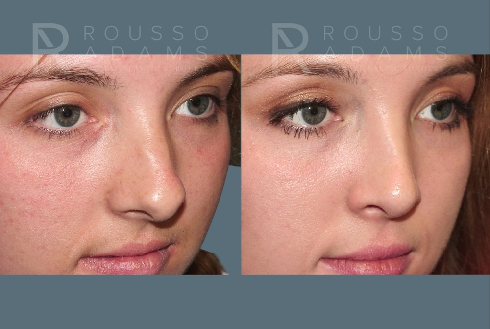 Rhinoplasty <span class=small>By Dr. Daniel Rousso</span> Before & After Gallery - Patient 271725 - Image 2
