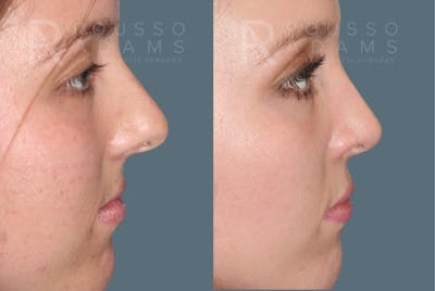 Rhinoplasty <span class=small>By Dr. Daniel Rousso</span> Before & After Gallery - Patient 271725 - Image 4