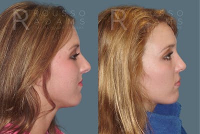 Rhinoplasty <span class=small>By Dr. Daniel Rousso</span> Before & After Gallery - Patient 271725 - Image 1