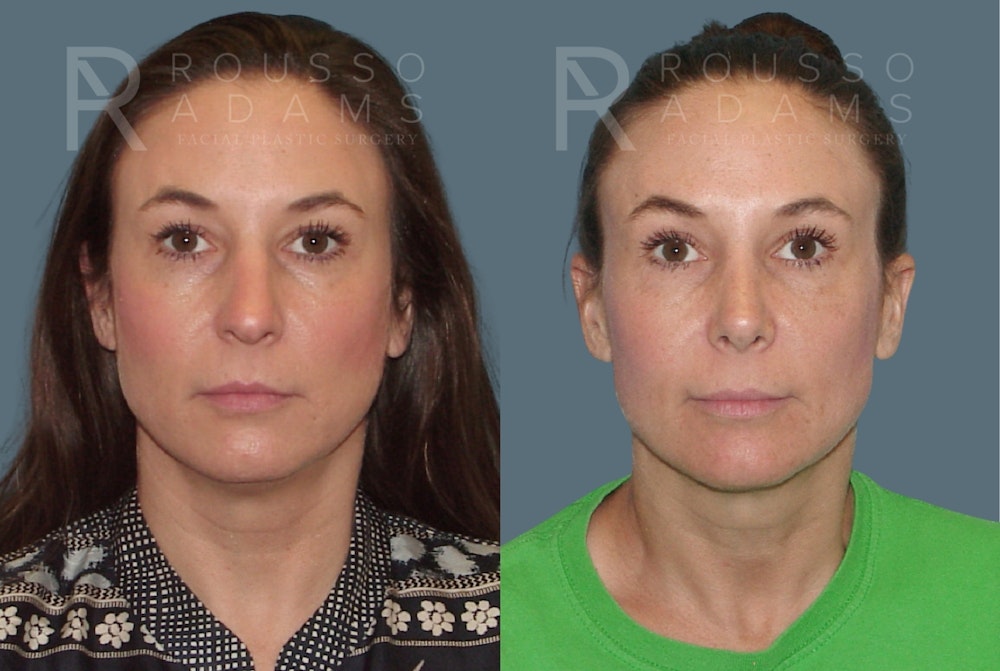 Rhinoplasty <span class=small>By Dr. Daniel Rousso</span> Before & After Gallery - Patient 814679 - Image 3