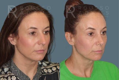 Rhinoplasty <span class=small>By Dr. Daniel Rousso</span> Before & After Gallery - Patient 814679 - Image 2