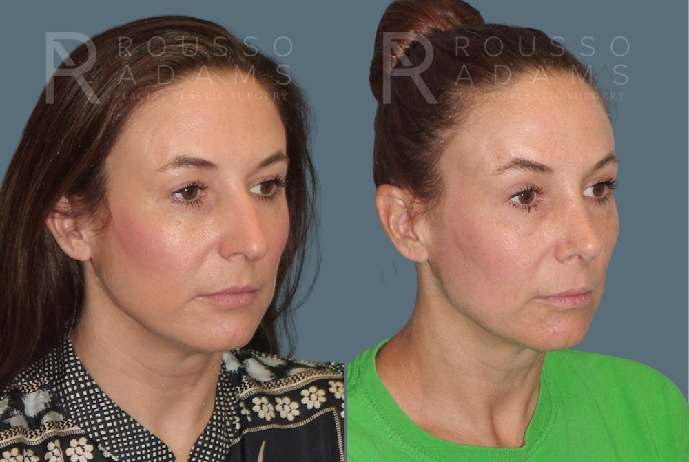 Rhinoplasty <span class=small>By Dr. Daniel Rousso</span> Before & After Gallery - Patient 814679 - Image 2