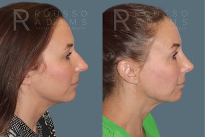 Rhinoplasty <span class=small>By Dr. Daniel Rousso</span> Before & After Gallery - Patient 814679 - Image 1