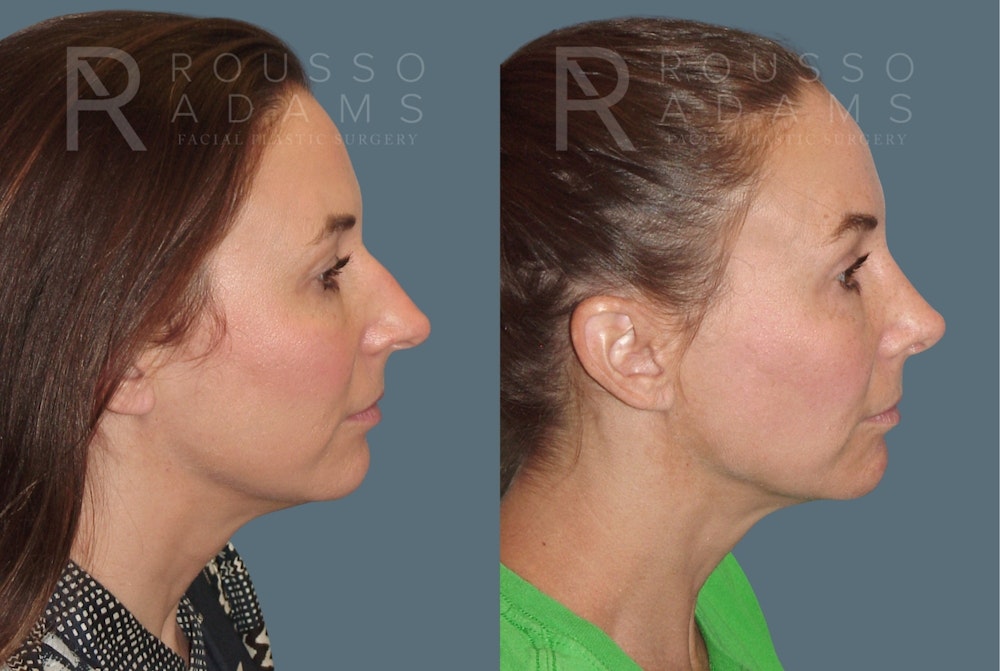 Rhinoplasty <span class=small>By Dr. Daniel Rousso</span> Before & After Gallery - Patient 814679 - Image 1
