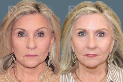 Deep Chemical Peel Gallery <span class=small>By Dr. Daniel Rousso</span> Before & After Gallery - Patient 203061 - Image 2