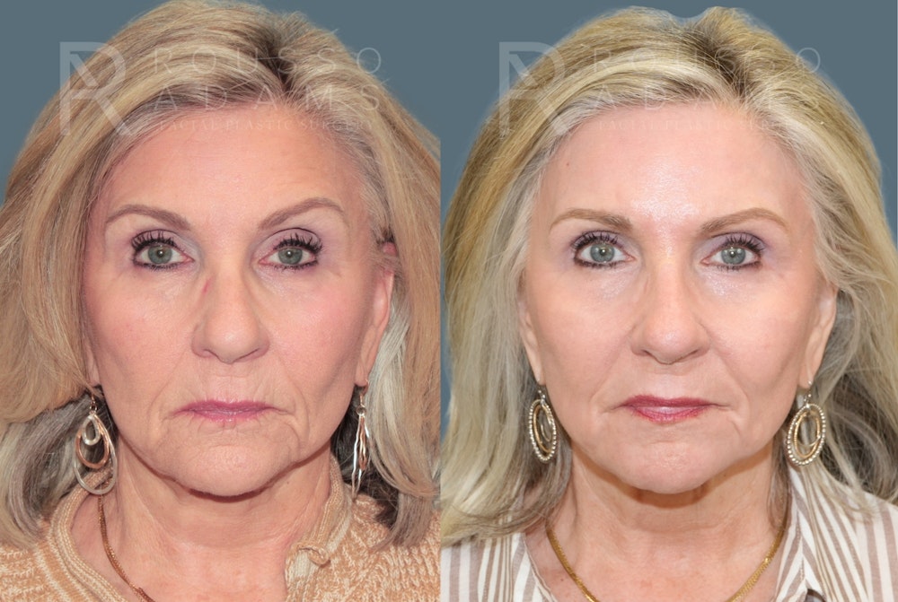 Deep Chemical Peel Gallery <span class=small>By Dr. Daniel Rousso</span> Before & After Gallery - Patient 203061 - Image 2