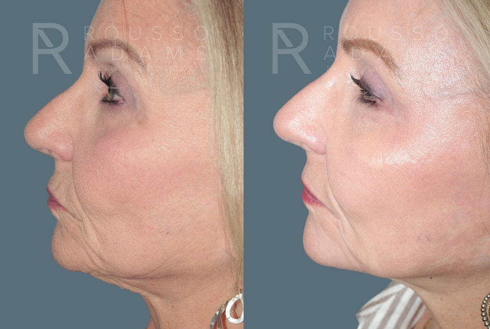 Deep Chemical Peel Gallery <span class=small>By Dr. Daniel Rousso</span> Before & After Gallery - Patient 203061 - Image 5